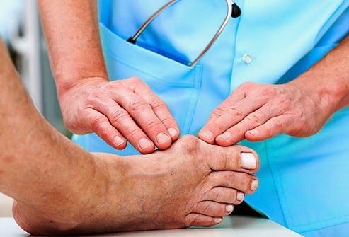 Bệnh gout thường gặp ở nam giới