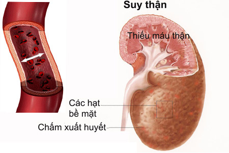 Chức năng thận suy giảm là nguyên nhân hàng đầu gây ra bệnh gout