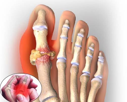 Gout là một bệnh lý xương khớp khó chữa