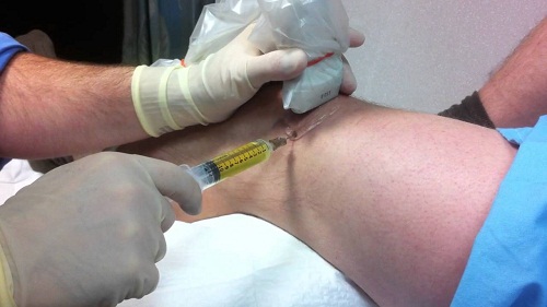 Đây là xét nghiệm để nhận biết được mức độ tổn thương tại khớp