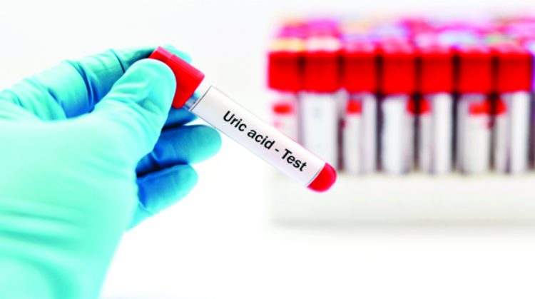 Xét nghiệm acid uric trong máu là điều vô cùng quan trọng và cần thiết