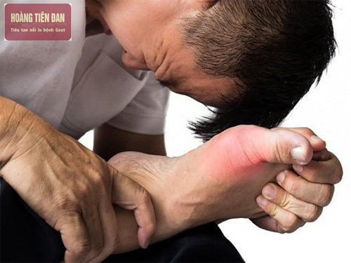Bệnh gout có thể gây ra nhiều biến chứng nghiêm trọng