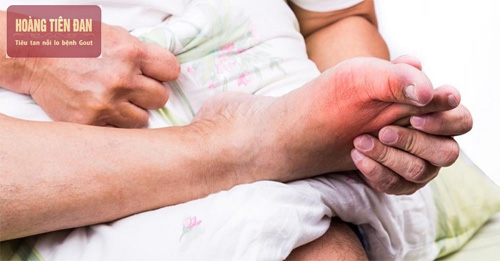 Khớp ngón chân cái có biểu hiện đau nóng và đỏ