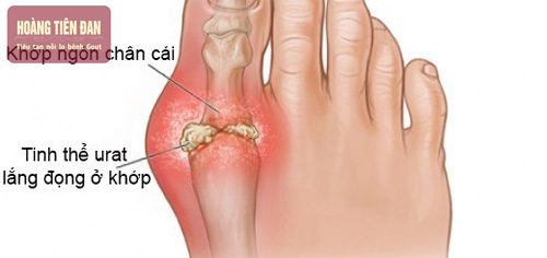 Cần phát hiện và điều trị kịp thời tránh các biến chứng nguy hiểm