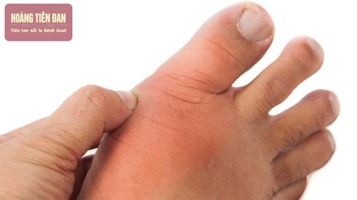 Nhận biết gout qua dấu hiệu lâm sàng