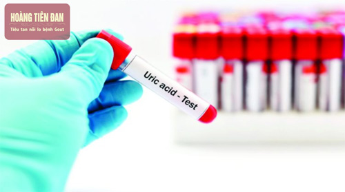 Xét nghiệm cận lâm sàng để chẩn đoán bệnh gout