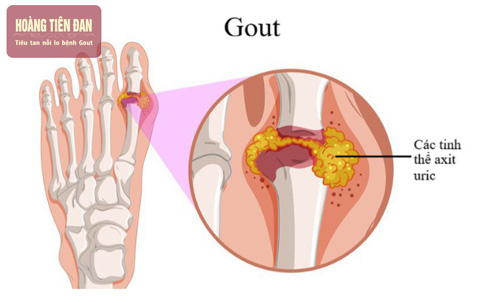 Nhận biết gout qua các chẩn đoán xác định