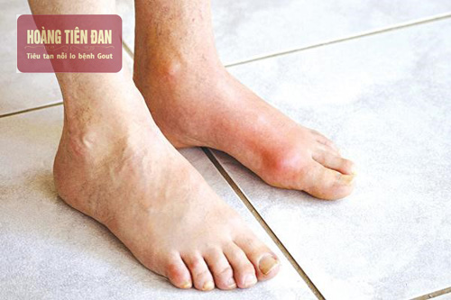 Có rất nhiều nguyên nhân gây ra bệnh gút