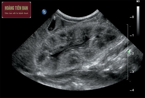 Siêu âm là một xét nghiệm thường được chỉ định để xác định bất thường ở thận