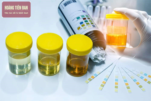 Tổng phân tích nước tiểu dùng để xác định một số bệnh