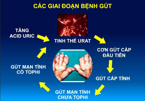 Quá trình hình thành hạt tophi quanh khớp