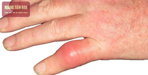 Đau nhức cổ tay và ngón tay có thể do những nguyên nhân cơ học