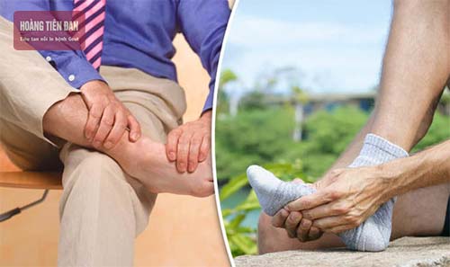 Nam giới từ 30 - 50 có nguy cơ mắc bệnh gout cao