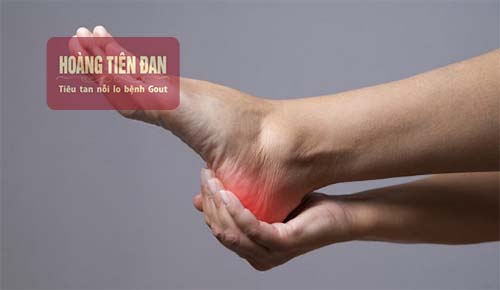 Bệnh gout ở gót chân gây sưng đau, nổi đỏ và nóng rát