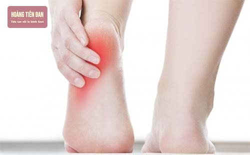 Bệnh gout ở gót chân