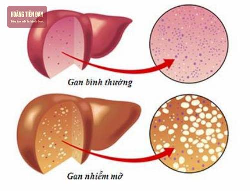 Hình ảnh cắt ngang mô phỏng gan bình thường và gan nhiễm mỡ