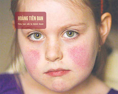 Bệnh gút ban đỏ có thể do yếu tố di truyền