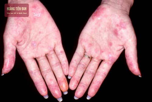 Bệnh gút ban đỏ thường xảy ra ở nữ giới nhiều hơn nam giới