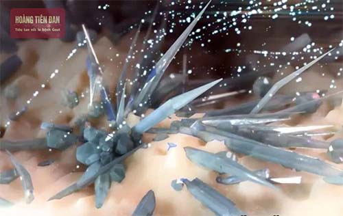 Hình ảnh cực đại của các tinh thể muối urat