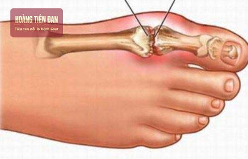 Các hạt urate natri lắng đọng trên các khớp xương