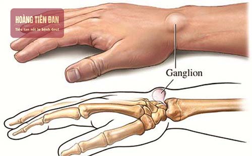 Gout làm sưng cổ tay có thể ảnh hưởng đến vận động cổ tay