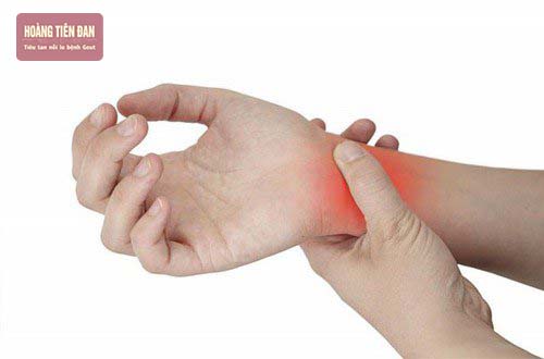 Cổ tay bị bệnh gout gây đau nhức