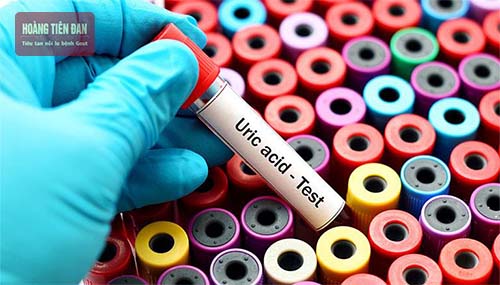 Chỉ số acid uric cao không có nghĩa là mắc bệnh gout