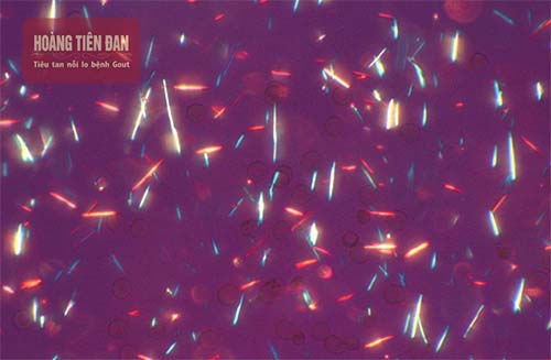 Giảm acid uric là điều kiện cần thiết cải thiện bệnh gout