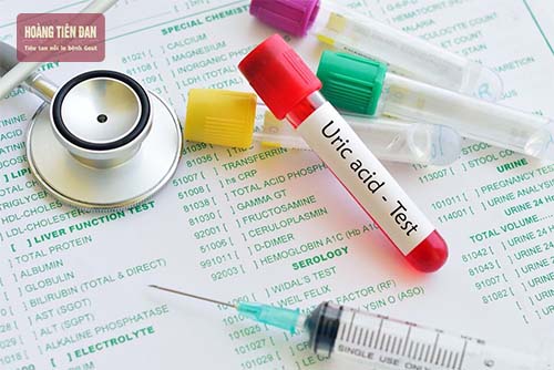 Nồng độ acid uric trong máu là nguyên nhân hình thành tinh thể urat trong dịch khớp