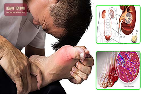Sỏi thận và bệnh gout gây ra do cùng một nguyên nhân