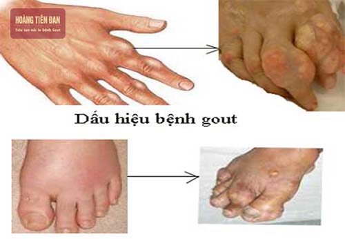 Bệnh gout sinh ra do nồng độ acid uric trong máu cao