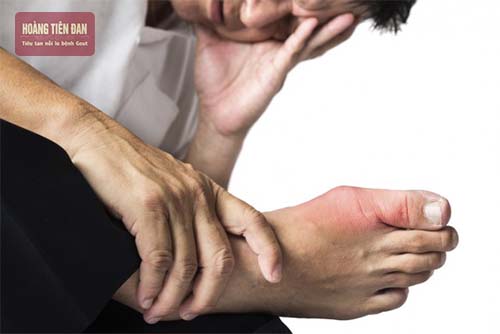 Bệnh gout được chia làm 4 giai đoạn