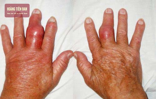 Nổi u cục ở đầu khớp ngón tay cũng có thể do bệnh gout