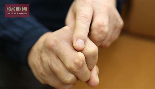 Nổi u cục ở đầu khớp ngón tay có thể là triệu chứng của bệnh thoái hóa khớp
