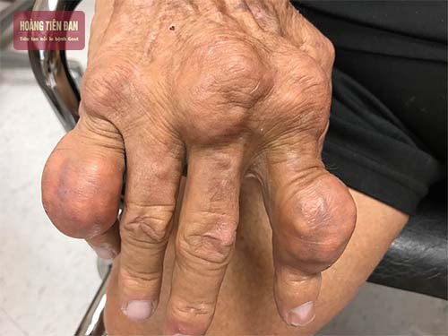 Nhiễm trùng do gout có thể phải cắt bỏ phần tri bị nhiễm trùng