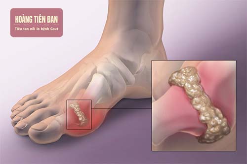Nguyên nhân nhiễm trùng do gout là do vỡ các hạt tinh thể tophi