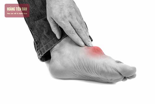 Acid uric trên 420 µmol/l kèm theo các cơn đau khớp  nguy cơ cao mắc phải bệnh gout