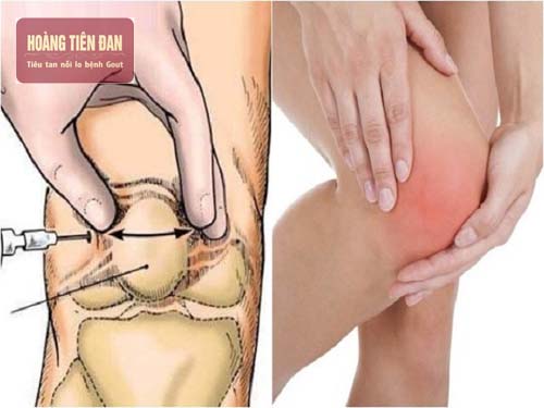 7. Các Nghiên Cứu Mới Về Gout