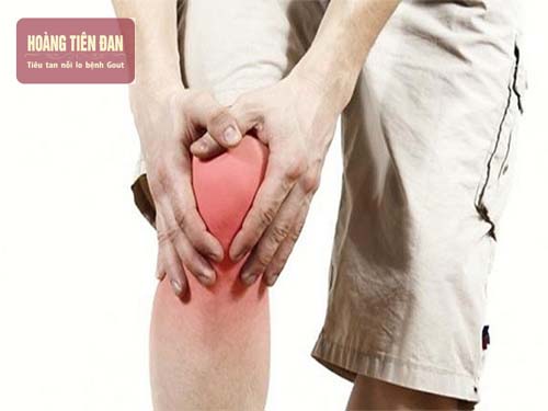 Đau khớp đầu gối là biểu hiện của bệnh gout