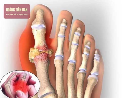 Acid uric tăng cao trong cơ thể hình thành bệnh gout