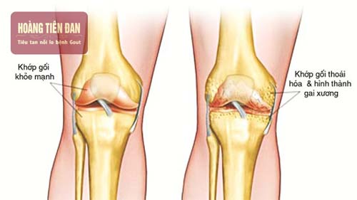 Bệnh gout cũng có thể dẫn đến bệnh thoái hóa khớp thứ phát
