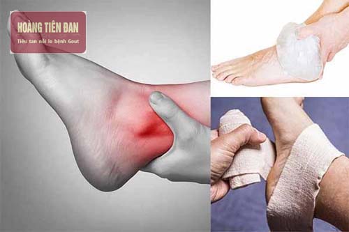  U bao dịch hoạt cổ chân có nguyên nhân từ chấn thương.