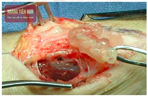 Phẫu thuật u bao dịch hoạt cổ chân.