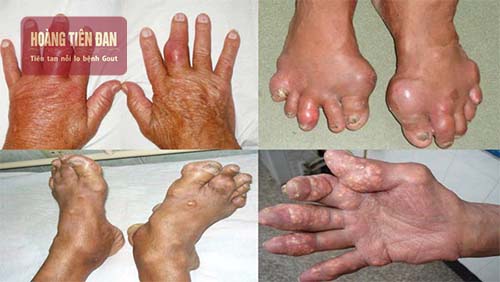 Những biến chứng kinh hoàng của bệnh gout