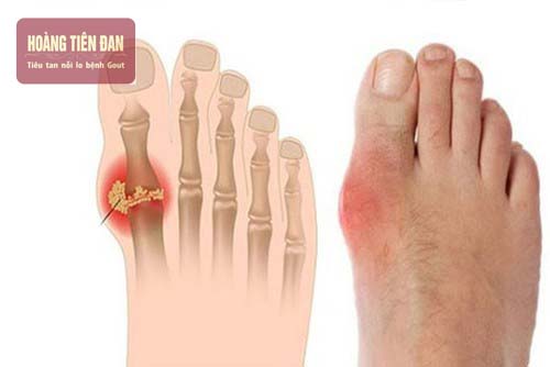 Người bị bệnh gout thường có biểu hiện sưng, đau nhức ở các khớp.