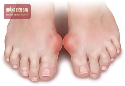Bệnh gout kéo dài có thể dẫn tới suy thận.