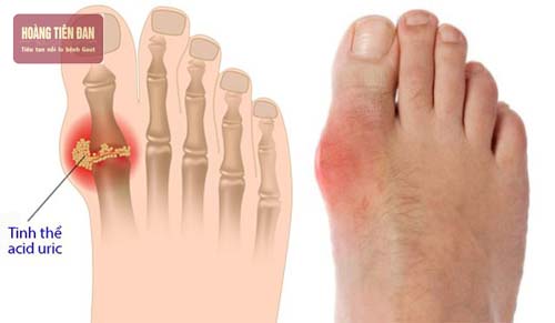 Sốt là một trong các triệu chứng xảy ra khi bị gout.