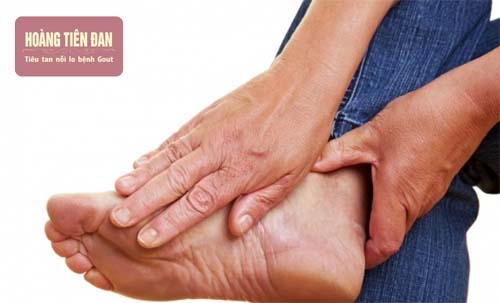 Bệnh gout có thể gây biến chứng đột quỵ, tàn phế.