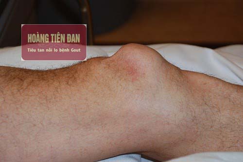 Xuất hiện các hạt tophi quanh khớp xương