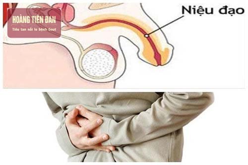 Bệnh gout và bệnh viêm niệu đạo có liên quan đến nhau